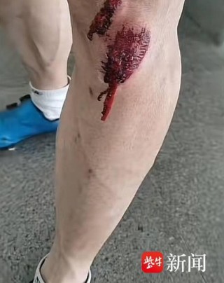 选手头部遭后车碾压伤情极为严重？安徽一自行车赛摔车事故致多人受伤